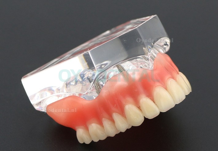 Tandheelkundige studie Tanden Model Overdenture met 4 implantaten Demo Model 6001